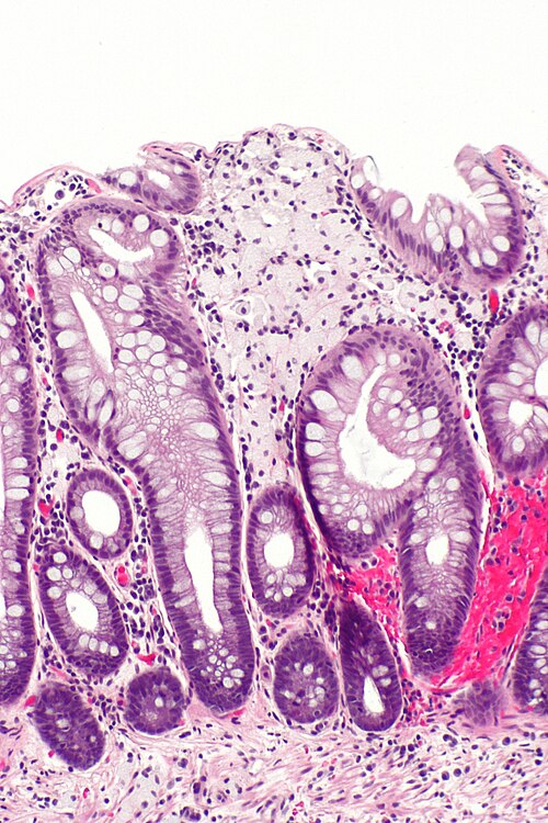 Xanthomatous polyp -- intermed mag.jpg