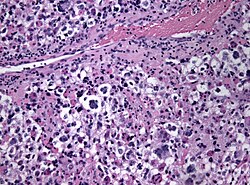 Anaplastic pxa histology.jpg