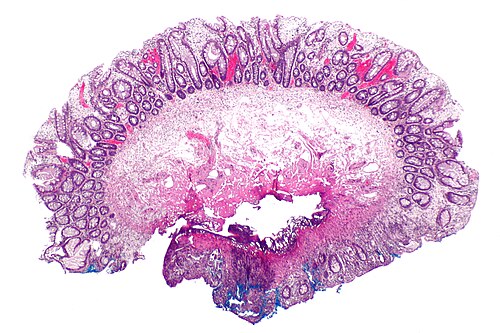 Xanthomatous polyp -- very low mag.jpg
