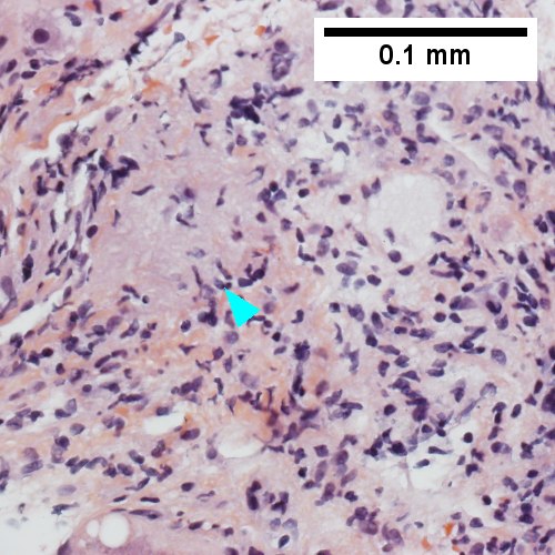 Triad without a bile duct. Macrophages & occasional lymphocytes without epithelioid cells needed for granuloma and space where bile duct likely once was [cyan arrowhead] (400X).