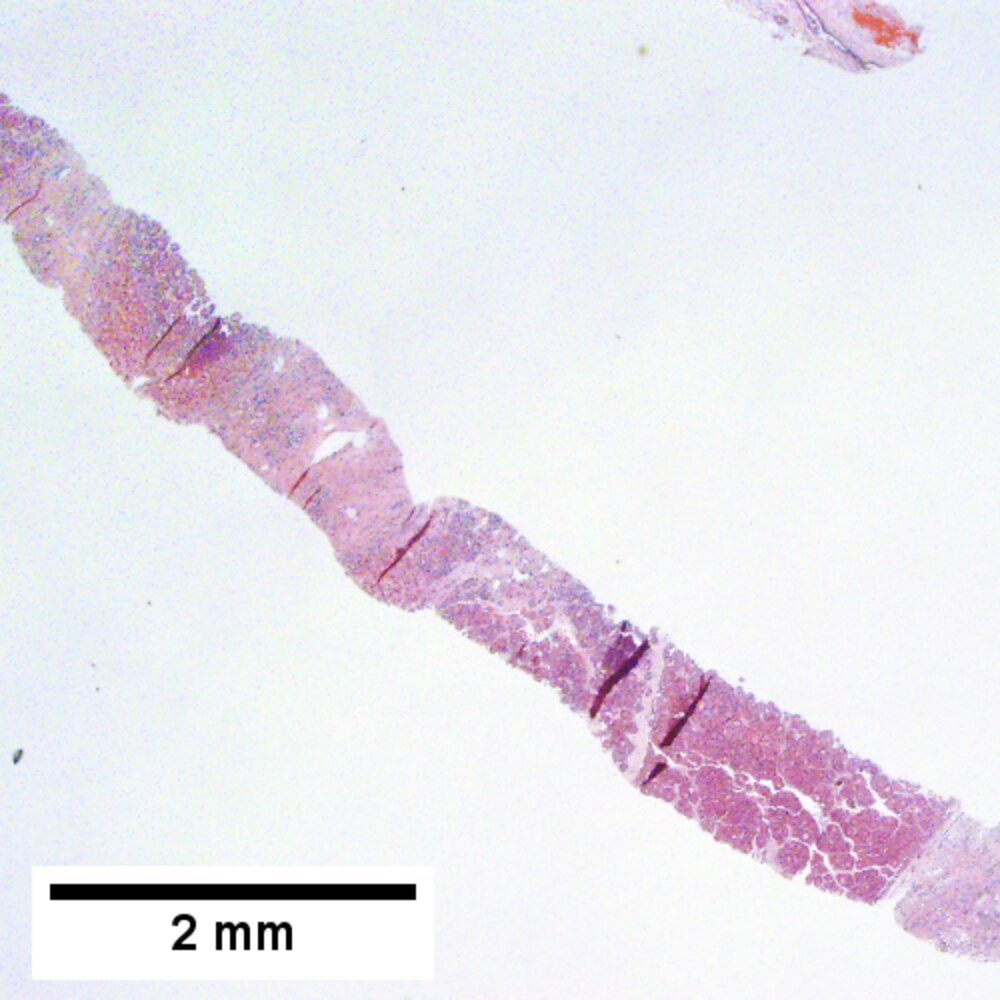 Hepatocellular carcinoma - Libre Pathology