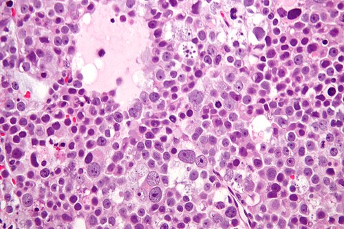 Spermatocytic seminoma high mag.jpg