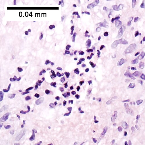 500x500px Center of previous granuloma showing pyknotic macrophage nuclei