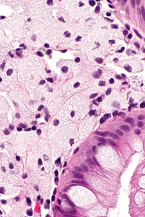 Xanthomatous polyp -- very high mag.jpg