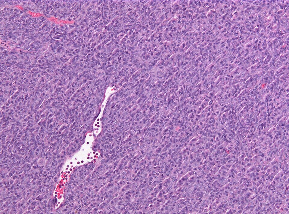 File:Neuropathology case VII 03.jpg