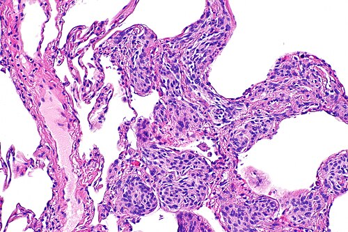 Pulmonary meningothelial-like nodule -- intermed mag.jpg