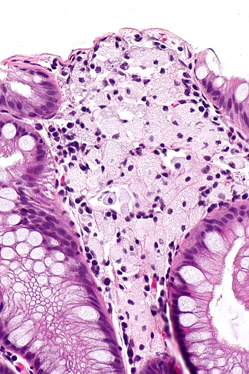 Xanthomatous polyp -- high mag.jpg