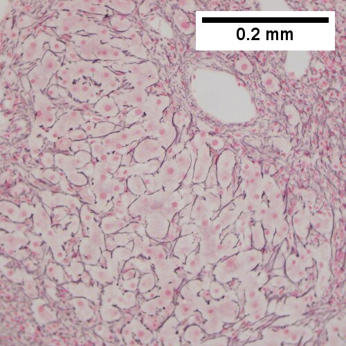 Hepatocellular carcinoma with fragments of liver afflicted by steatosis & with regenerative, benign fragments.