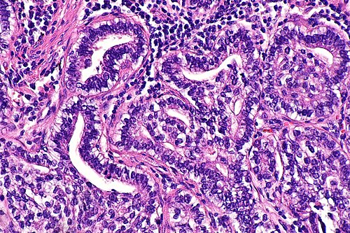 Fetal adenocarcinoma of the lung -- high mag.jpg