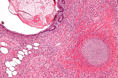 Teratoma intermed mag.jpg