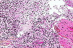 Glioblastoma - high mag.jpg