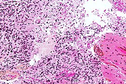 Glioblastoma - high mag.jpg