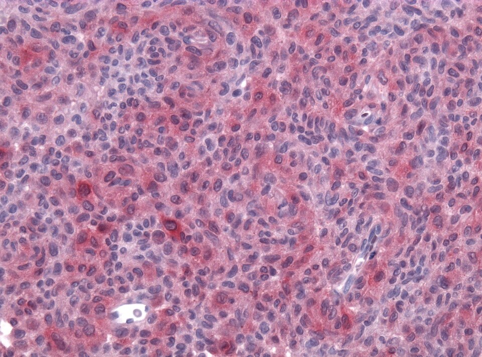 File:Neuropathology case VII 06.jpg