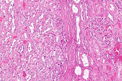 Unclassified renal cell carcinoma in BHD -- intermed mag.jpg