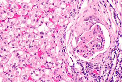 SDH-deficient renal cell carcinoma - high mag.jpg