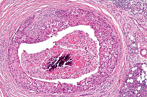 Salivary duct carcinoma - intermed mag.jpg
