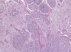 Brain invasion meningioma.jpg