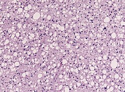 Astrocytoma whoII HE.jpg