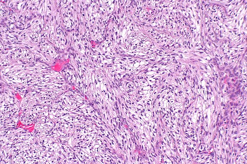 Sarcomatoid differentiation in renal cell carcinoma -- intermed mag.jpg