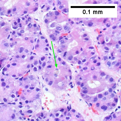 The tumor has cancerous nuclei; note the bile which makes for absolute diagnostic certainty [arrow] (Row 2 Left 400X).