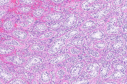 Intertubular seminoma - alt -- low mag.jpg