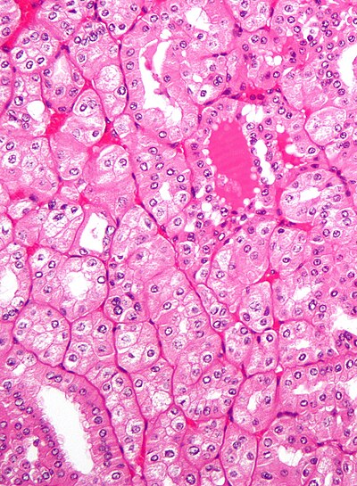 Chromophobe renal cell carcinoma, eosinophilic variant - high mag.jpg