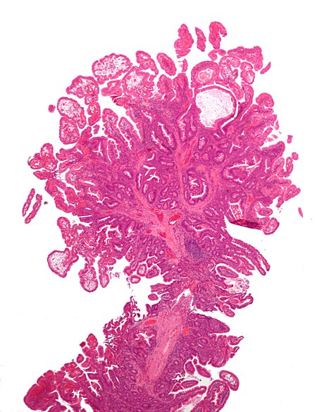 Peutz-Jeghers polyp - Libre Pathology