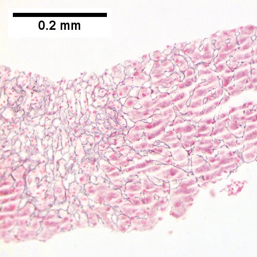 Submassive hepatic necrosis.